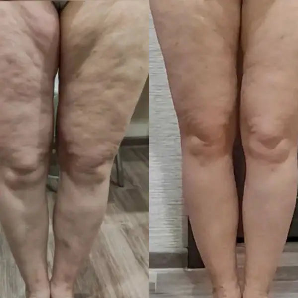 MASAJEADOR ANTICELULITIS