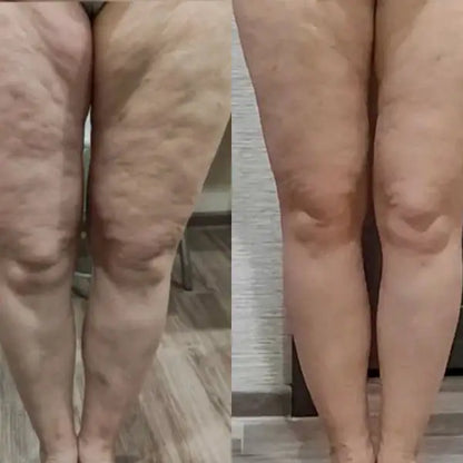 MASAJEADOR ANTICELULITIS